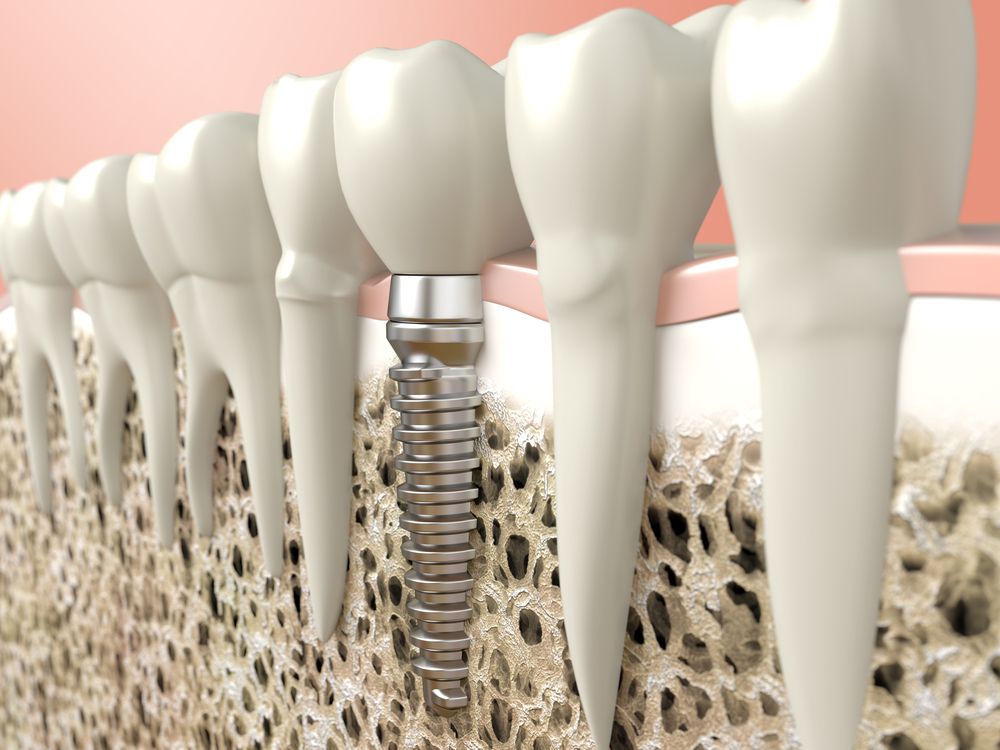Какие зубные импланты прослужат всю жизнь